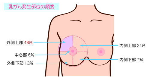乳がん発生部位の頻度