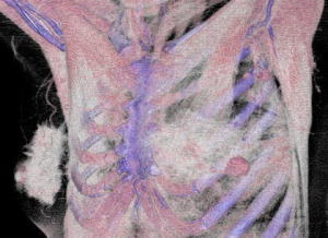 乳がんCT３D画像